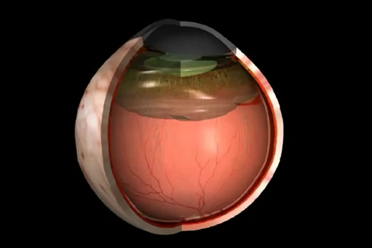 Retinal Detachment