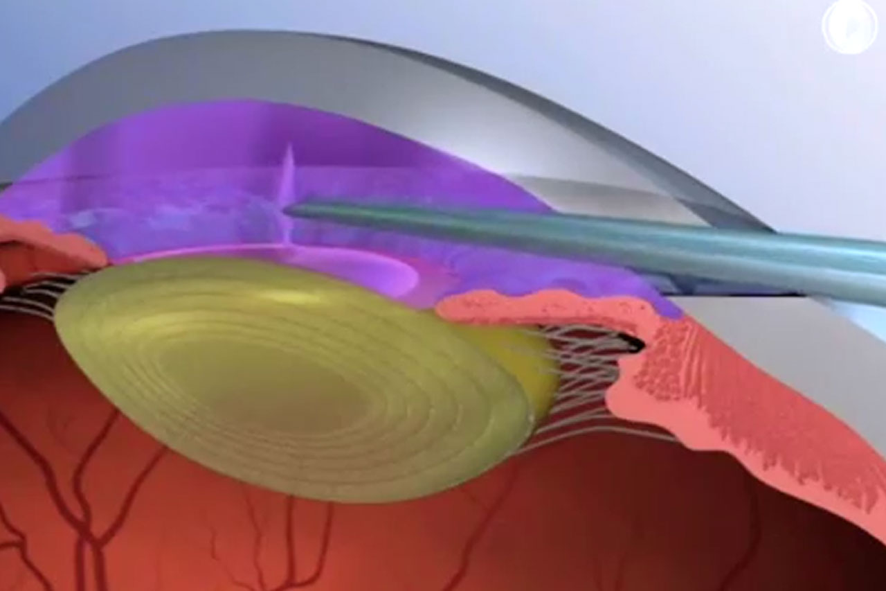 Cataract Surgery Animation Image