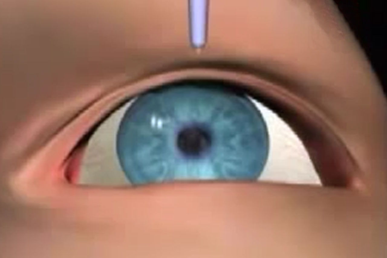 Glaucoma Treatment