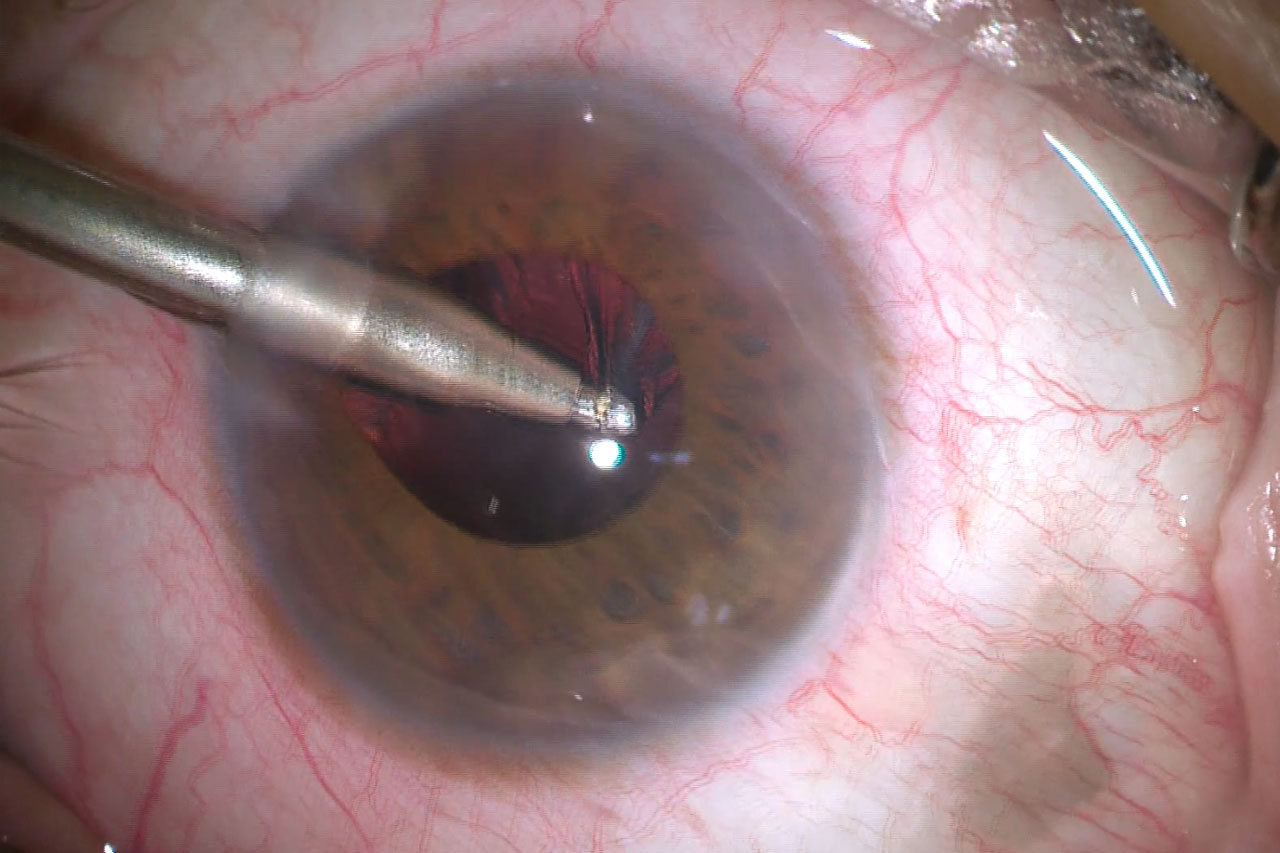 Real Cataract Surgery Video Image